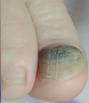 Antes del tratamiento de Onicomicosis (hongo)